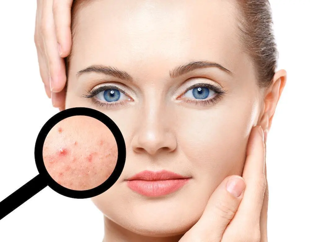 Role of Hormones in Acne: What You Can Do