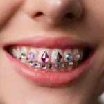 Safe Removal of Tooth Gems: How to Do It Without Damaging Enamel