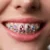 Safe Removal of Tooth Gems: How to Do It Without Damaging Enamel